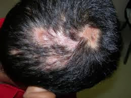 Shingles on scalp: Pictures, symptoms and treatment for Shingles on