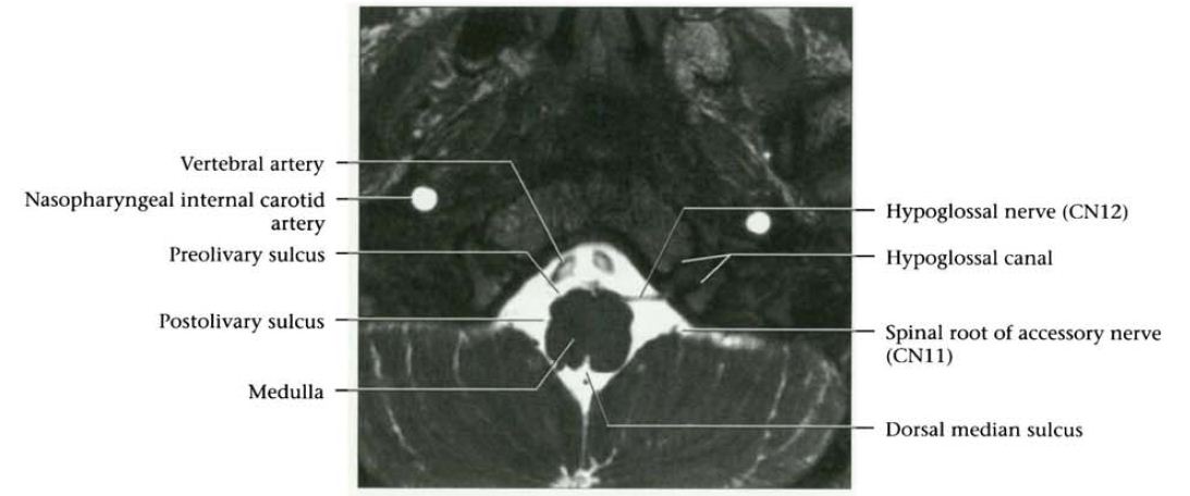 Mri Cranial Nerves