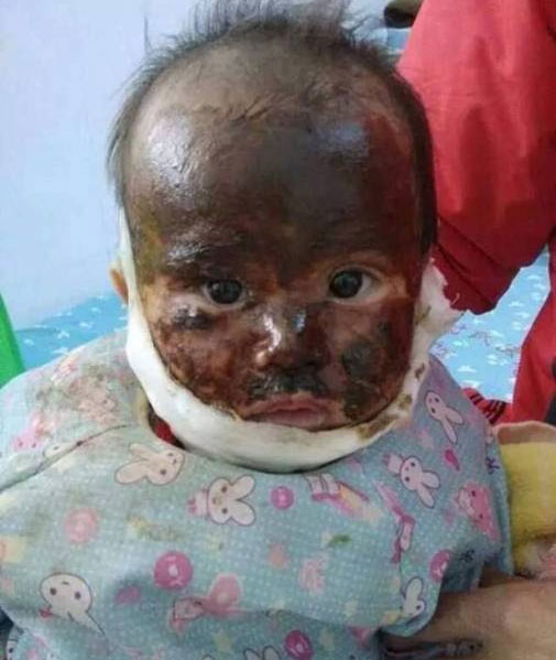 Hình ảnh bé gái đáng thương bị phá hủy toàn bộ khuôn mặt vì bỏng