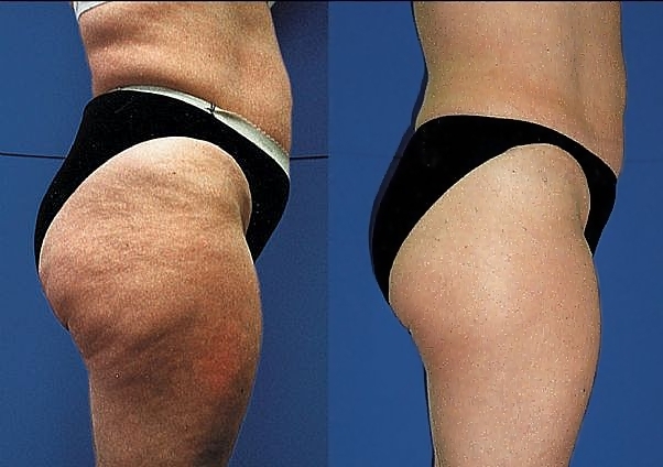 Cellulite Marc De Caf Ef Bf Bd Cellulite Marc De Caf Ef Bf Bd