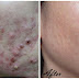 How To Get Rid Bad Pimples And Acne - Home Remedies