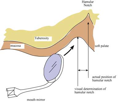 patient preparation for primary impression hamular notch