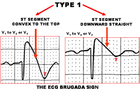 Brugada Syndrome Ecg