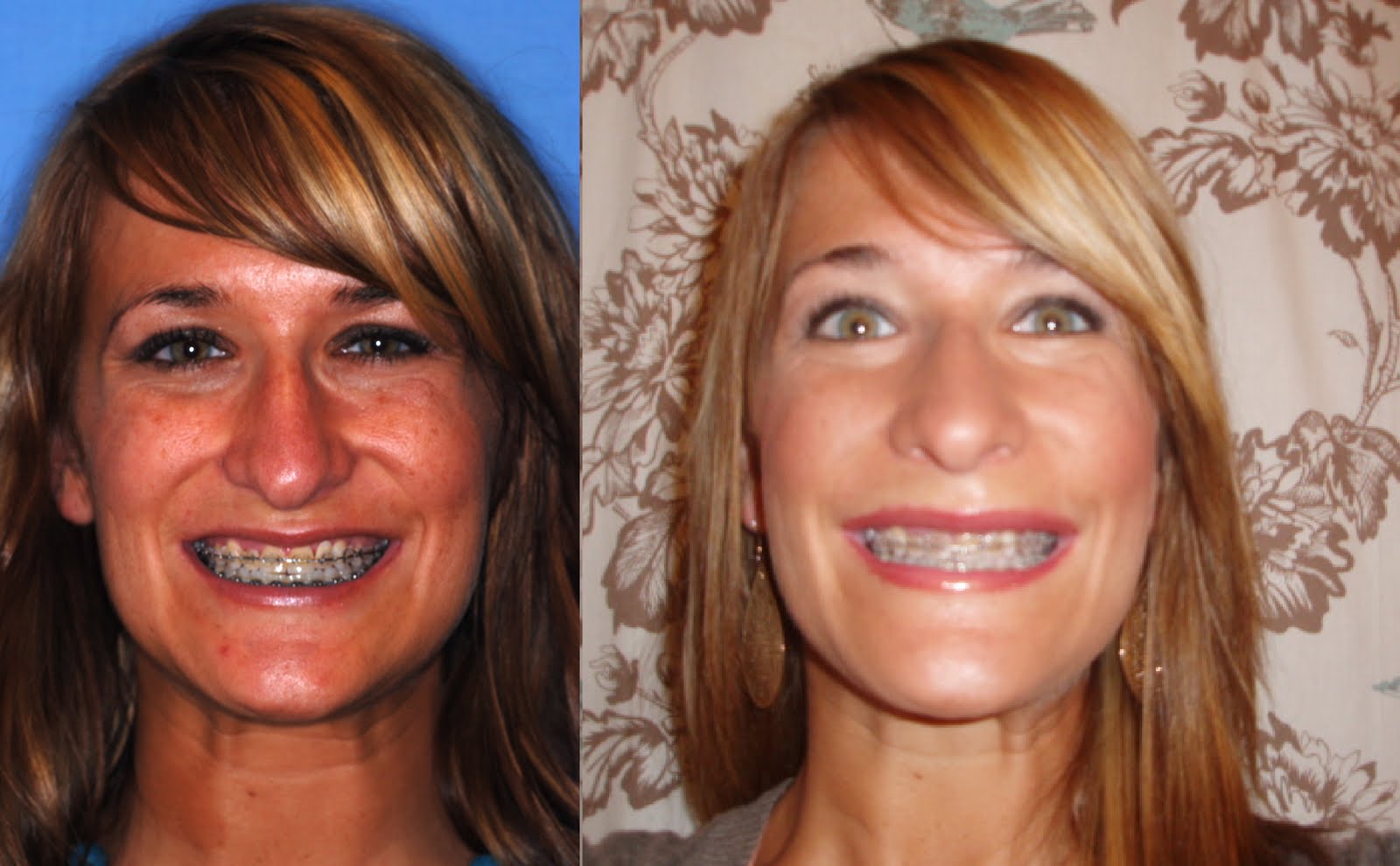 lefort osteotomies