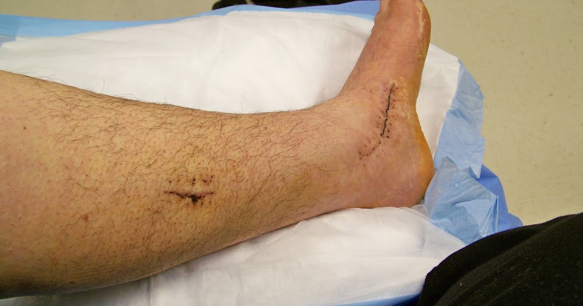 tibial tendon