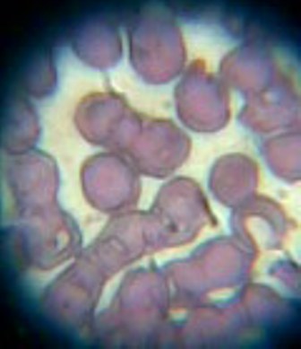 Rbc in sperm Epstein barr virus facial nerve palsy