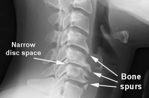 The Mechanism of Neck Arthritis The Mechanism of Neck Arthritis