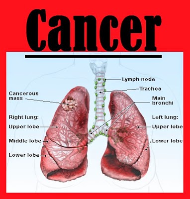 stage 4 lung cancer survival rate