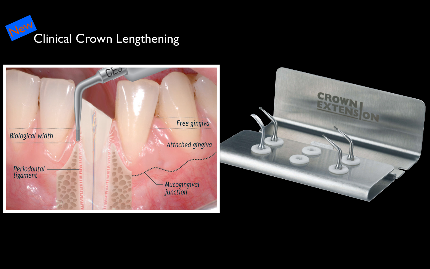Dental implant professional Crown Lengthening with New Device