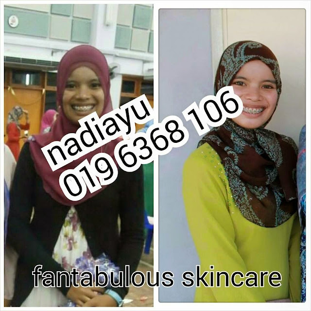 masalah jerawat,fantabulous skincare,nadiayu