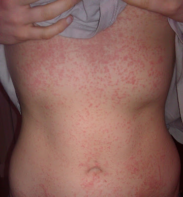 Steroid injection for allergic rash