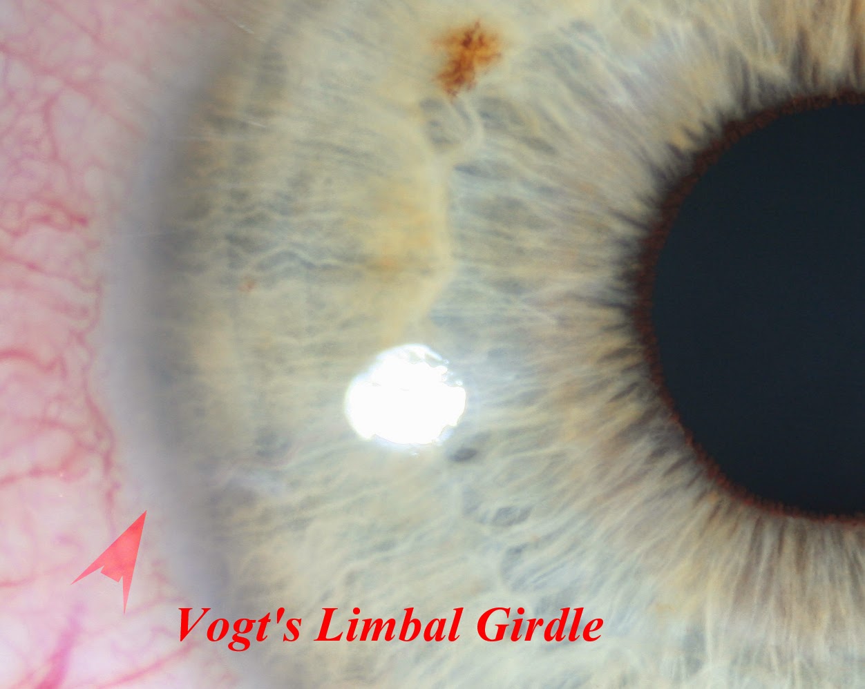 Modern & Multidimensional Iridology: Vogt's Limbal Girdle