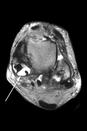 MRI Musculo-Skeletal Section: Tear of tibialis posterior