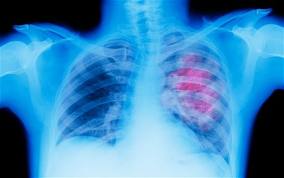 Lung Cancer, Causes Know Before So Sacrifice