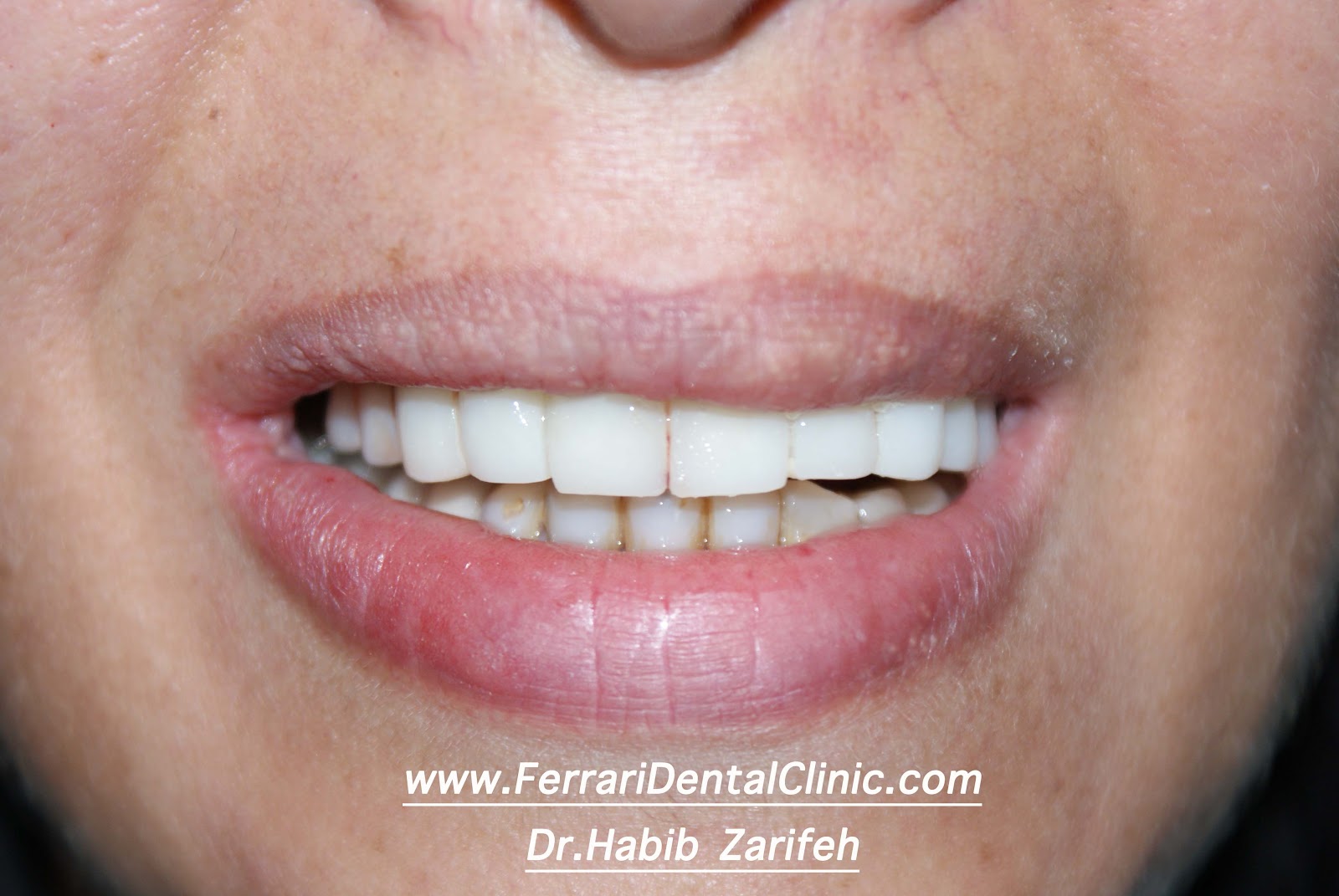 Dental implants Lebanon specialist Dr.Habib Zarifeh