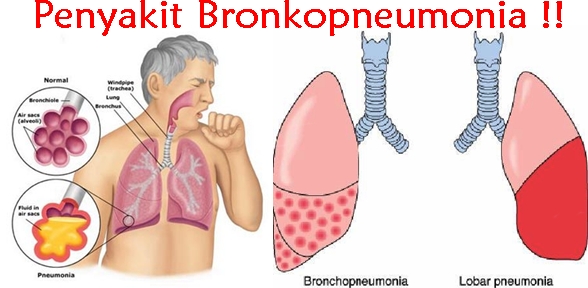 Cara Mengatasi Bronkopneumonia