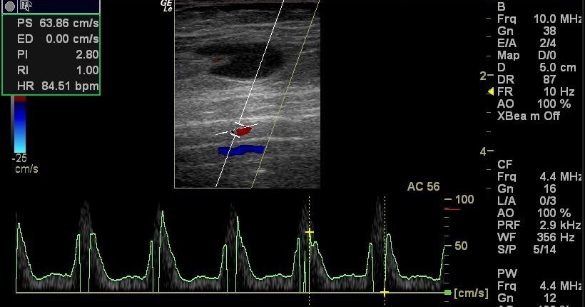 cochinblogs: Doppler study-Severe stenosis of the lower limb arteries