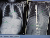 Before and after VEPTR implant 1-4-12
