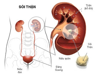 Những hiểu lầm tai hại khi chữa sỏi thận