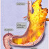 Causes explanation GERD disease Causes explanation GERD disease