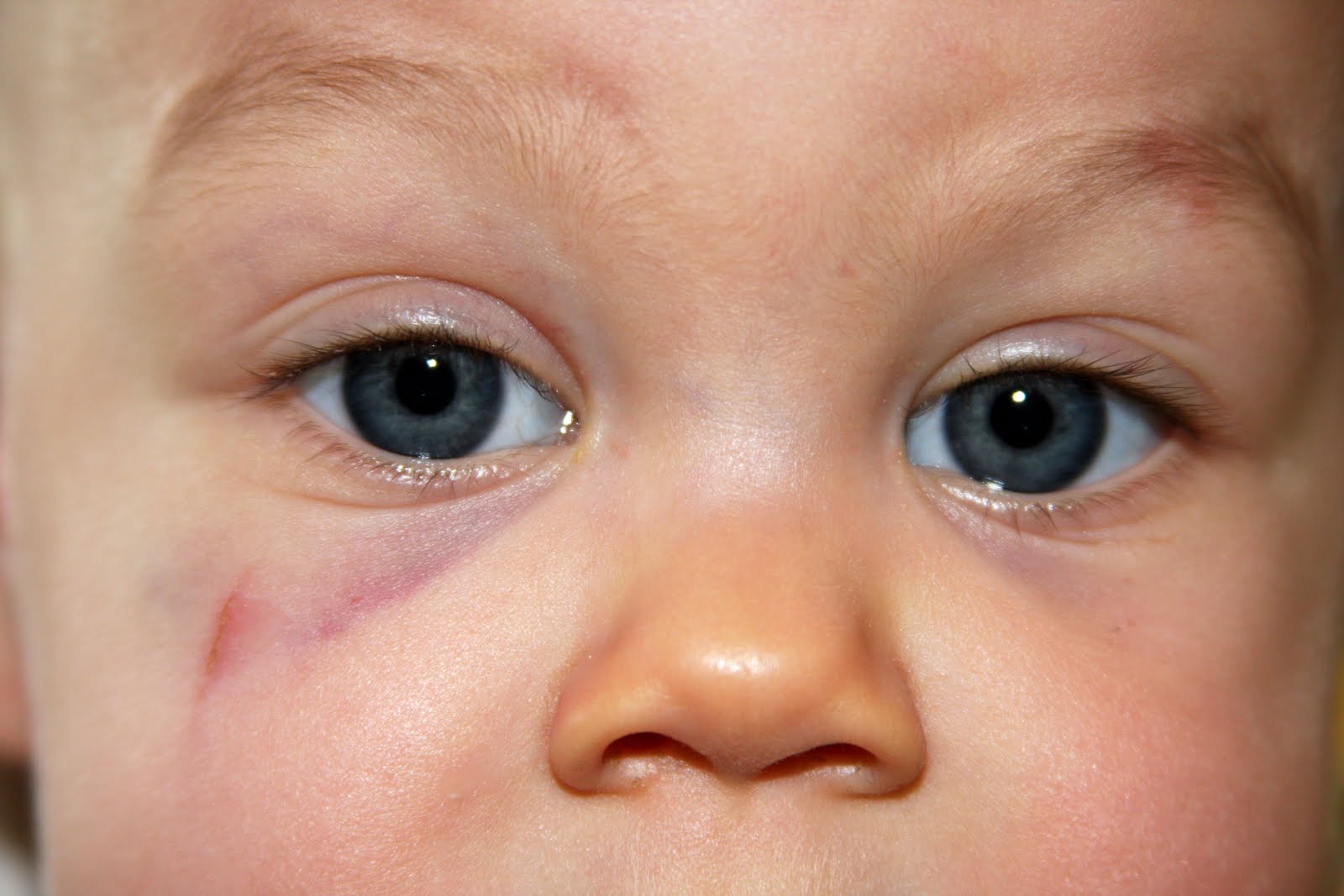 ...and baby makes FOUR First Black Eye