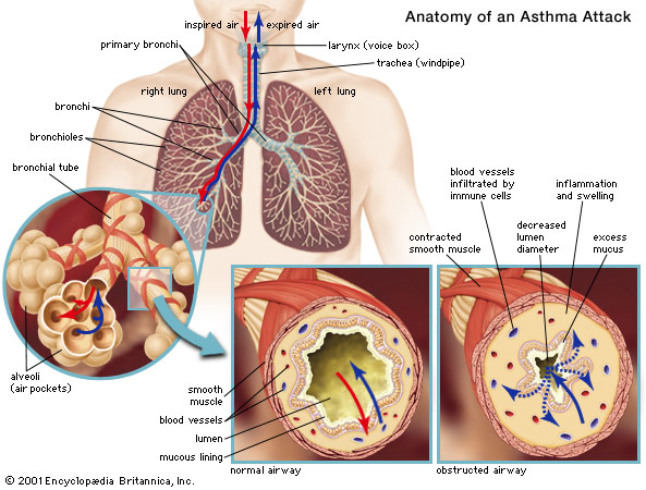 Airway Asthma