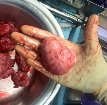 Medical Minstrel: OB/GYN: Fibriods