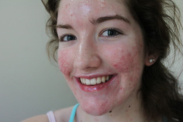 dating ugly guys with pimples dating ugly guys with pimples