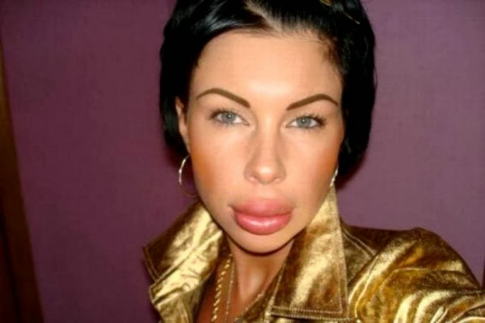 GoosBall: 15 Worst Plastic Surgery Fails