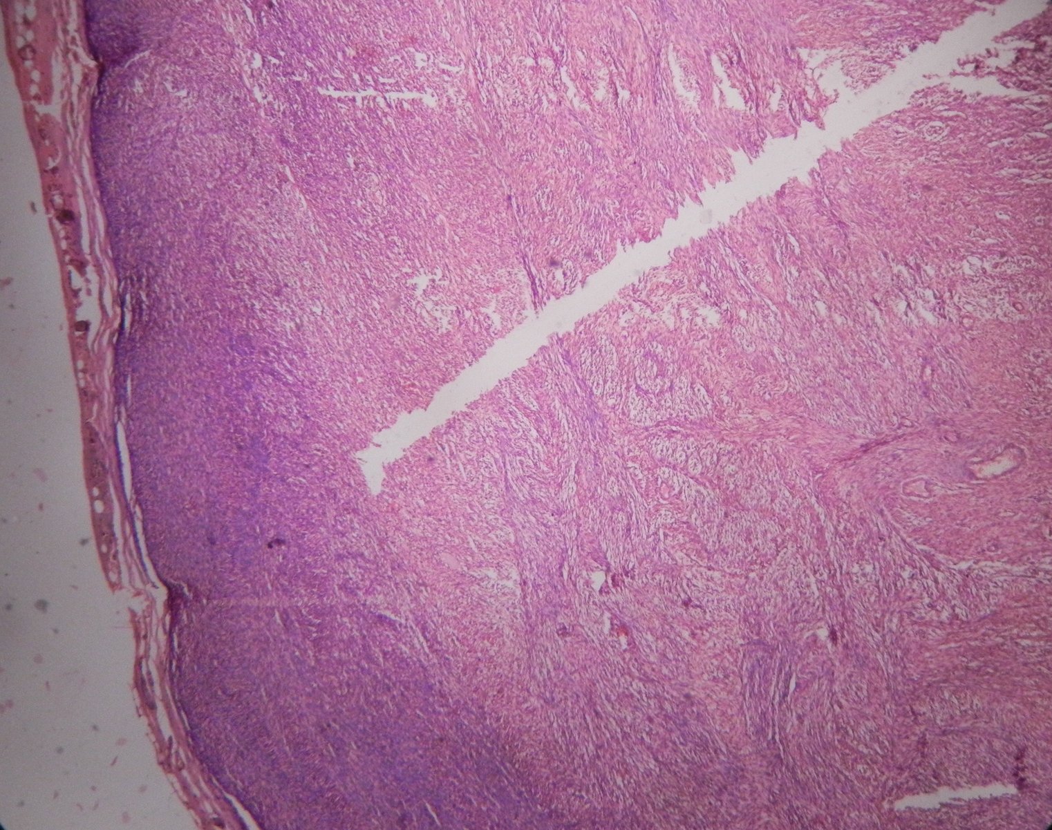 Soft tissue neoplasms