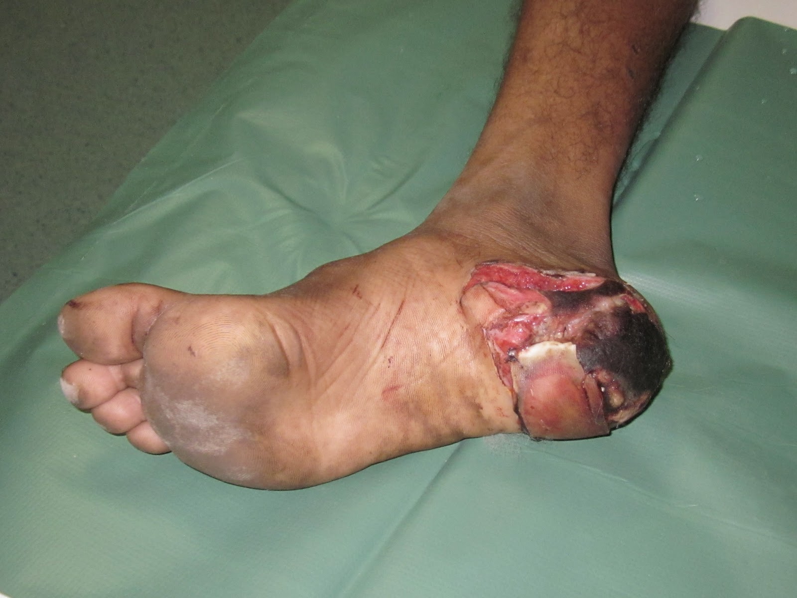 Necrotic Foot