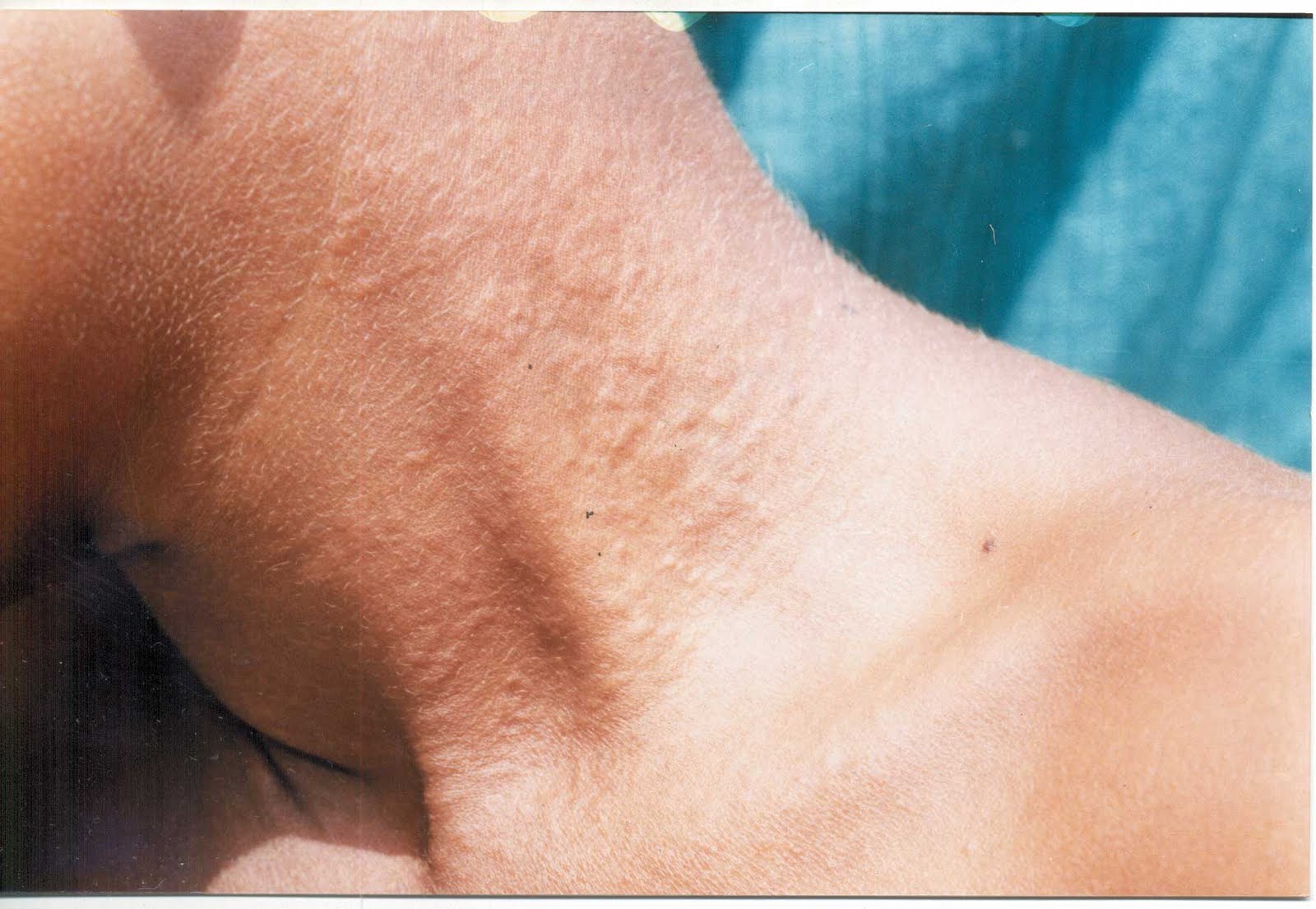 Genetic Skin Conditions
