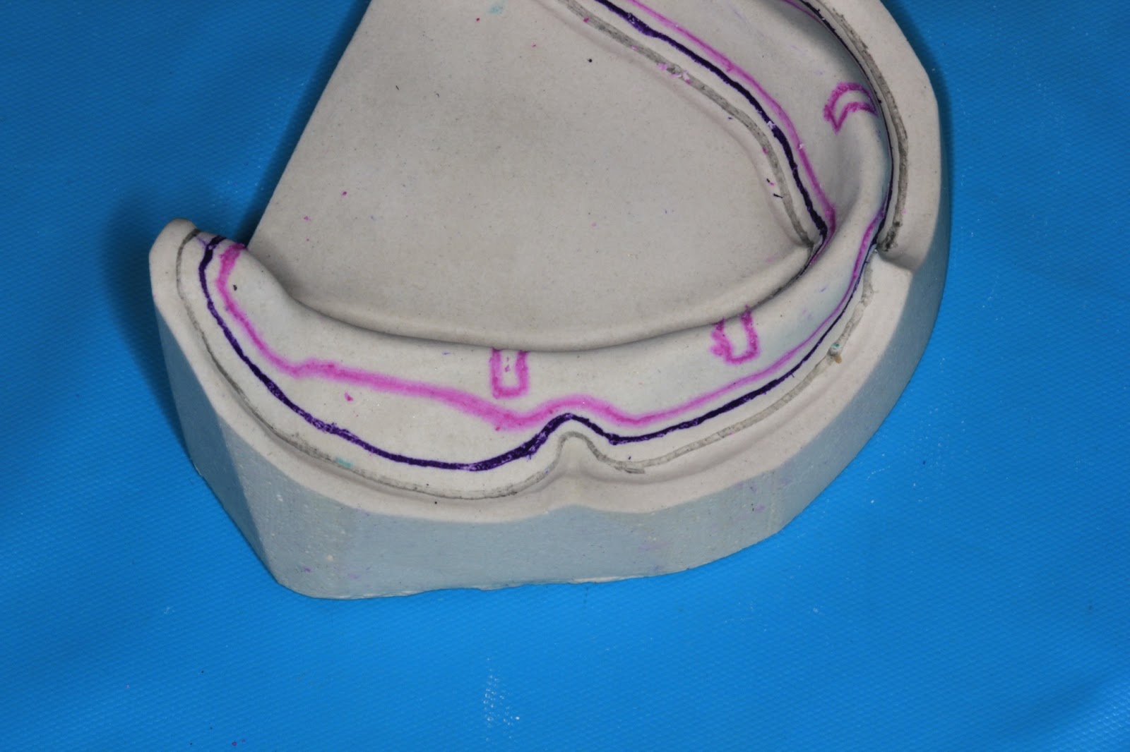 Step by step Guide for Understanding the Prosthodontics Spacer for