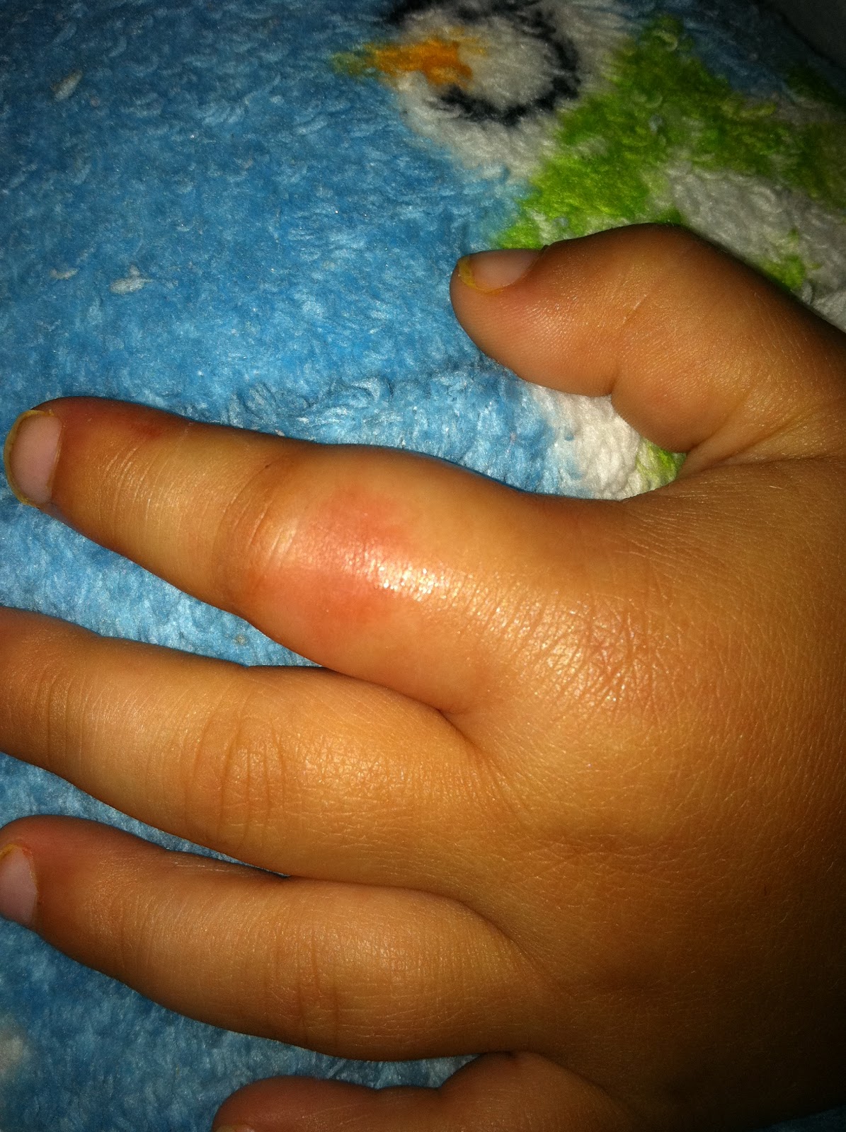 Across The Pond Smashed Finger Oh No