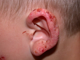 Informatii medicale despre eruptia juvenila de primavara a urechilor