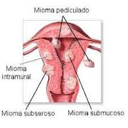 Pengobatan Penyakit Mioma Miom+1