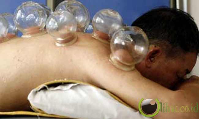 Cupping Cupping