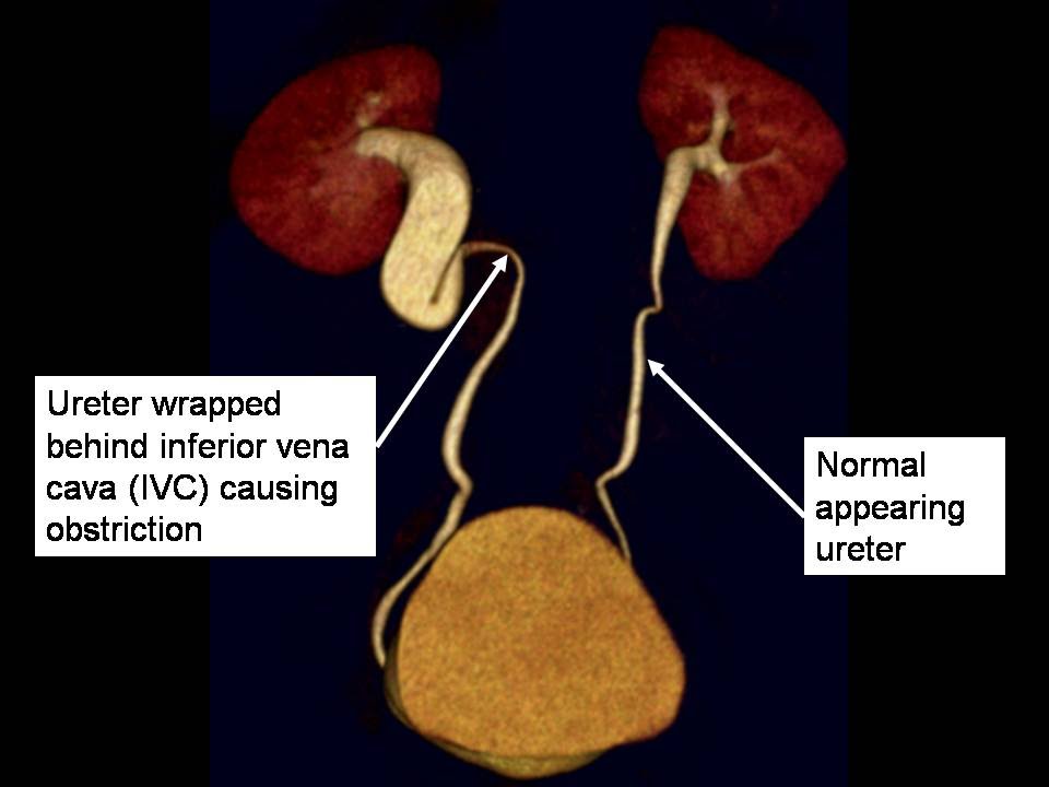 HEALTH FROM TRUSTED SOURCES Urinary tract obstruction