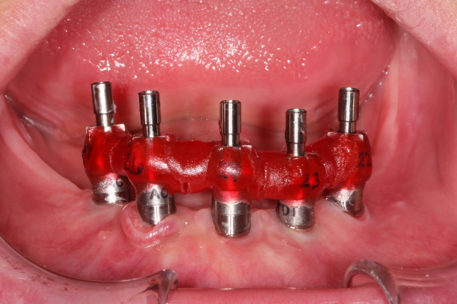 Boise Idaho Prosthodontics Intraoral Luting of Implant Verification