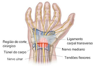 Cirurgia síndrome do túnel do carpo