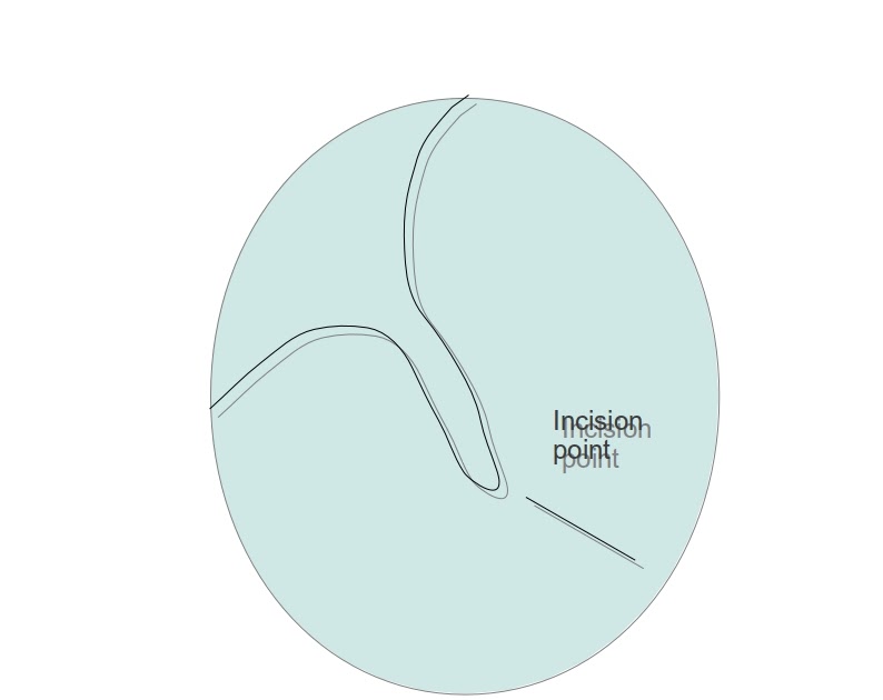 Tutorials in otolaryngology Grommet insertion Revised indication