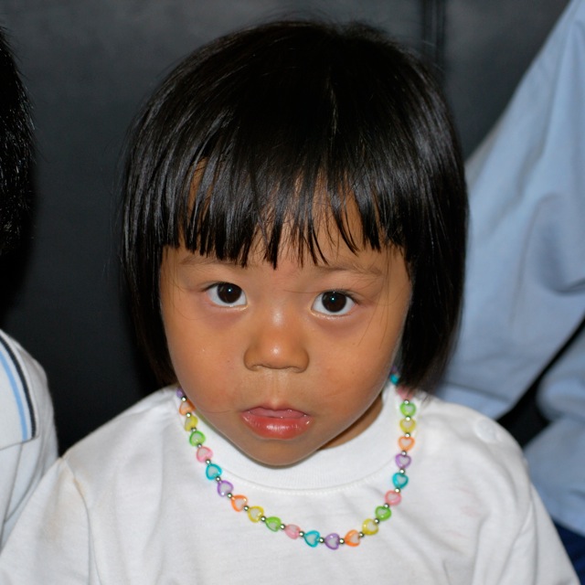 Bring my sons from afar... Before and After Tongue Reduction Surgery