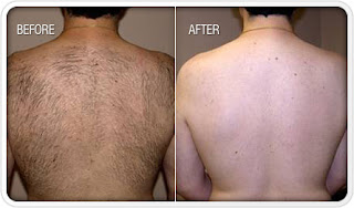 , MEN AND UNWANTED BODY HAIR