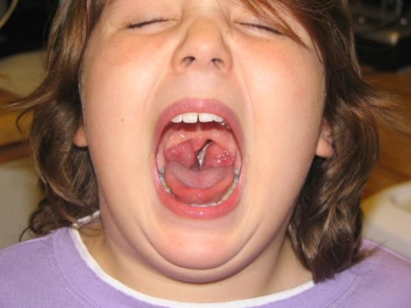Tonsiliths Pictures : The Best Way To Remove Tonsil Stones