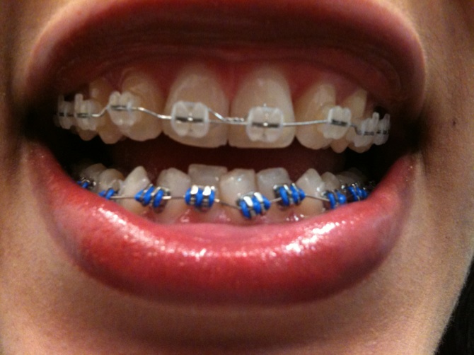 Braces Update and coils picts after trim
