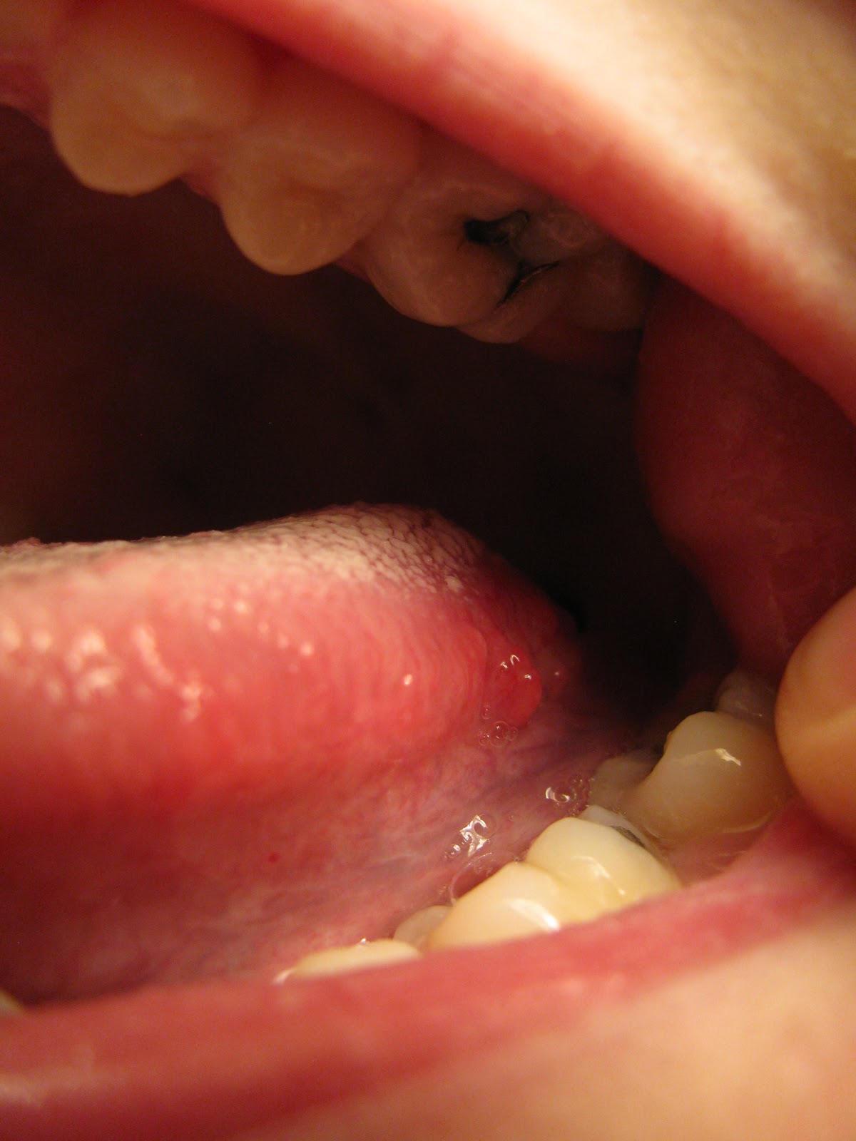 Tongue Disease