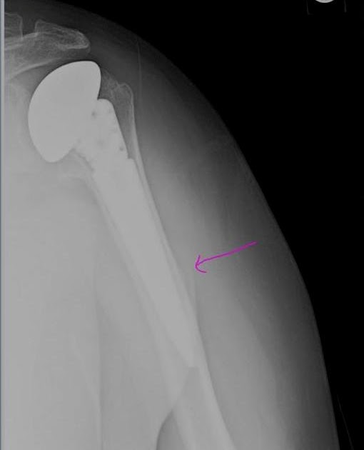 How to read Xray after the TSA (total shoulder arthroplasty) Sumer's