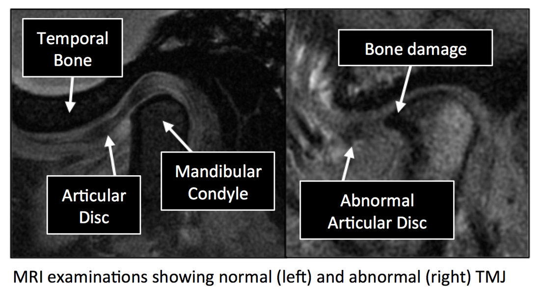 Radiology Anatomy Images TemporoMandibular Joint MRI anatomy