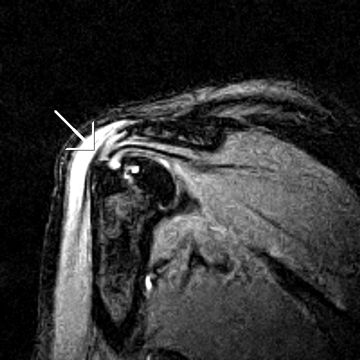 Pitching InjuryMRI Shoulder Sumer's Radiology Blog