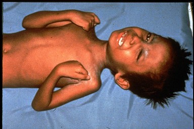 Iow Penyakit Dan Kelainan Pada Tulang Otot Manusia